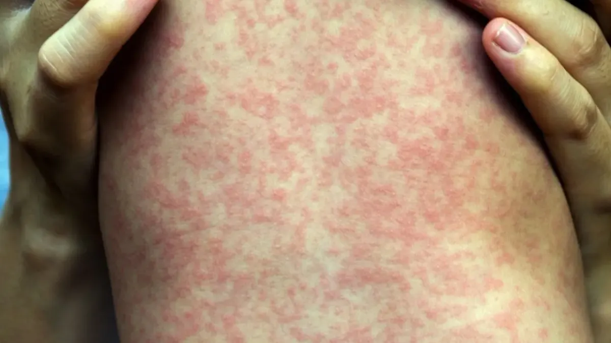 Suben a 25 los casos de sarampión en Chihuahua