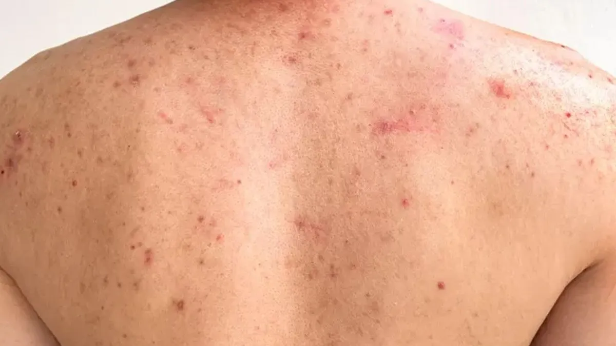¿Barritos en la espalda? Con estas sencillas recomendaciones puedes prevenirlos